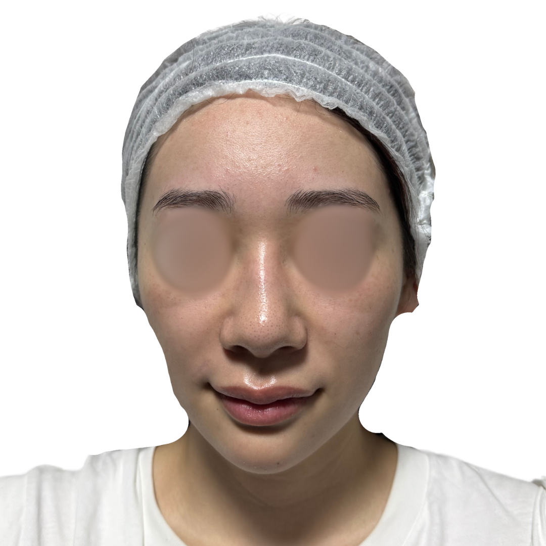 水光注射（スキンブースター）